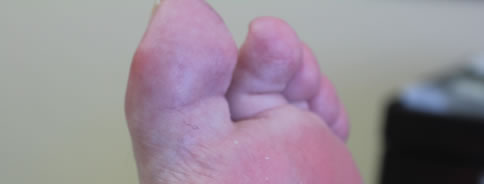 Rheumatoid Arthritis