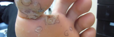 It shows multiple verrucas on a child's foot, which were treated successfully with conservative treatment using chemicals.