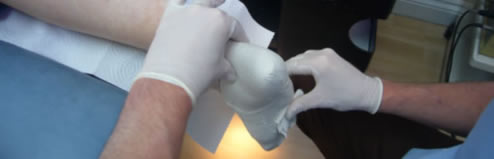 The taking of a negative cast in neutral position